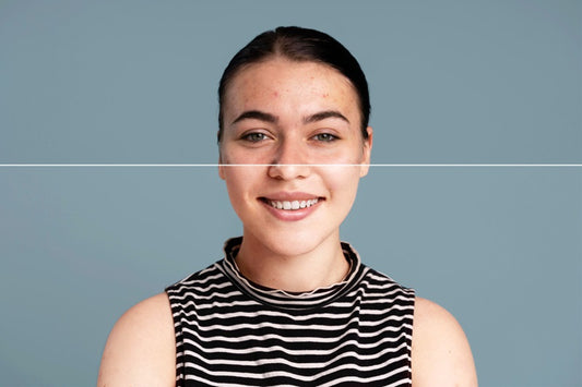 What If You Could Get Rid of Acne Without Surgery?