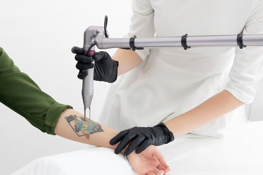What Should You Know Before Getting a Tattoo Removed?