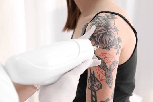 Why People Want To Remove Their Tattoo?