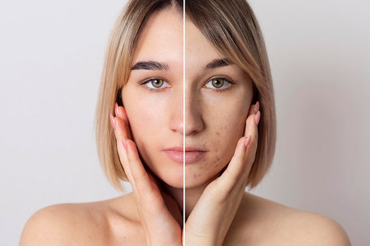 Bye-bye Clogged Pores: BBL™ Therapy for Skin that Shines