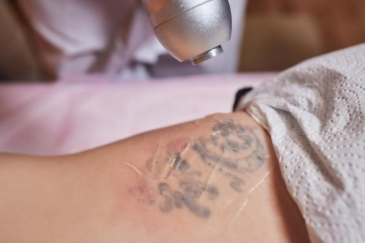 Mastering Tattoo Removal: 6 Key Success Influences