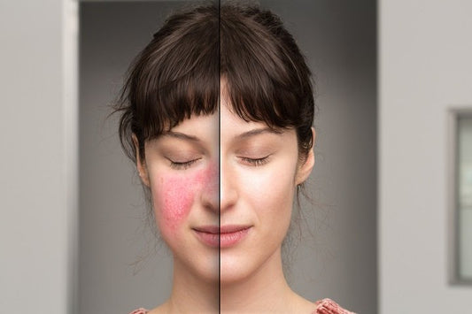 Radiance Reborn: Illuminating Acne's Defeat Through BBL