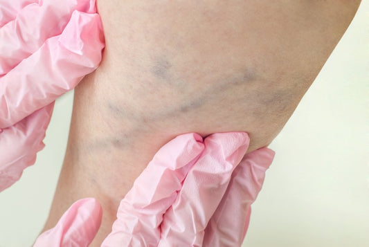 Spider Vein Appearance and Its Treatment