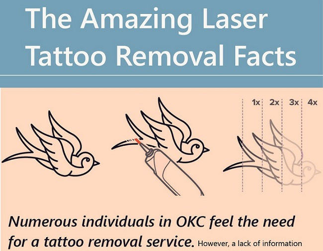 The Amazing Laser Tattoo Removal Facts