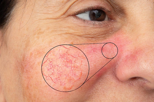 The Path To Tackling Facial Redness From Spider Veins