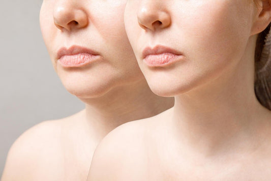 Facelifts Unveiled: The Right Lift for Your Wrinkles