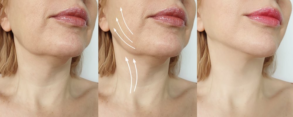 Knowing More About Liquid Facelift