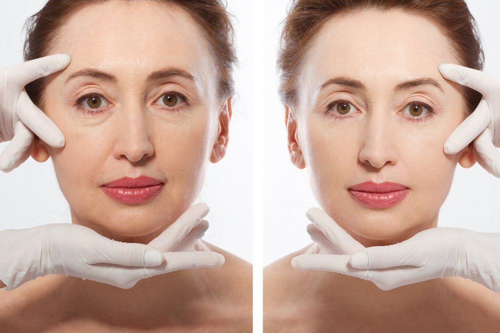 Letting All The Doubts Disappear Regarding Non-Surgical Facelift