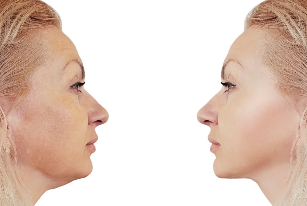 Kybella Is the Answer Behind Your Vanishing Double Chin