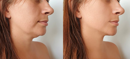 4 Things You Should Know Before Getting Kybella Treatment