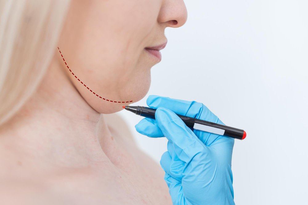 Kybella: The Magical Process to Embrace Beauty