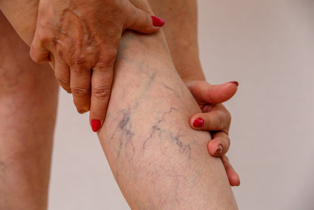 Spider Veins: Best Home Remedies to Aesthetic Treatment
