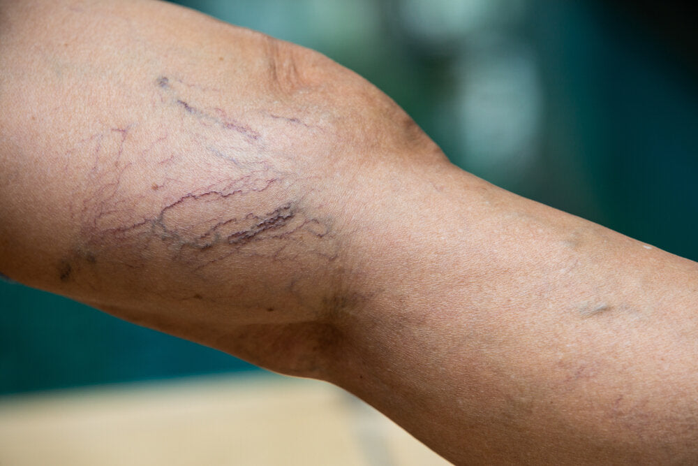 Facts about Spider Vein You Ought to Know