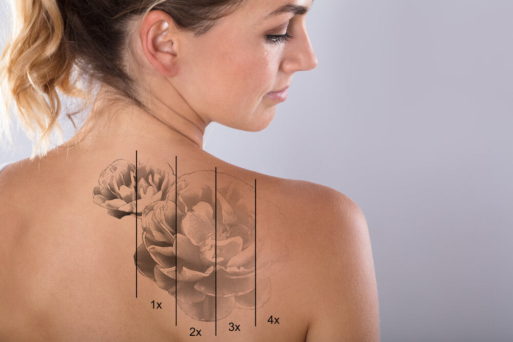 How to Select a Good Clinic for Tattoo Removal?