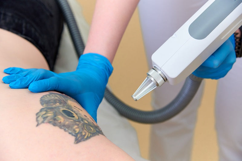Why Is Laser Tattoo Removal Your Best Bet for Ink Regret?