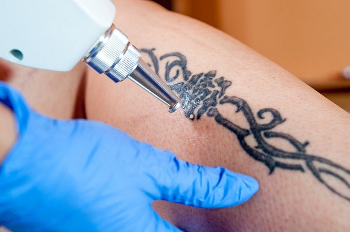 The Irksome Safety Hazards in Tattoo Removal Creams