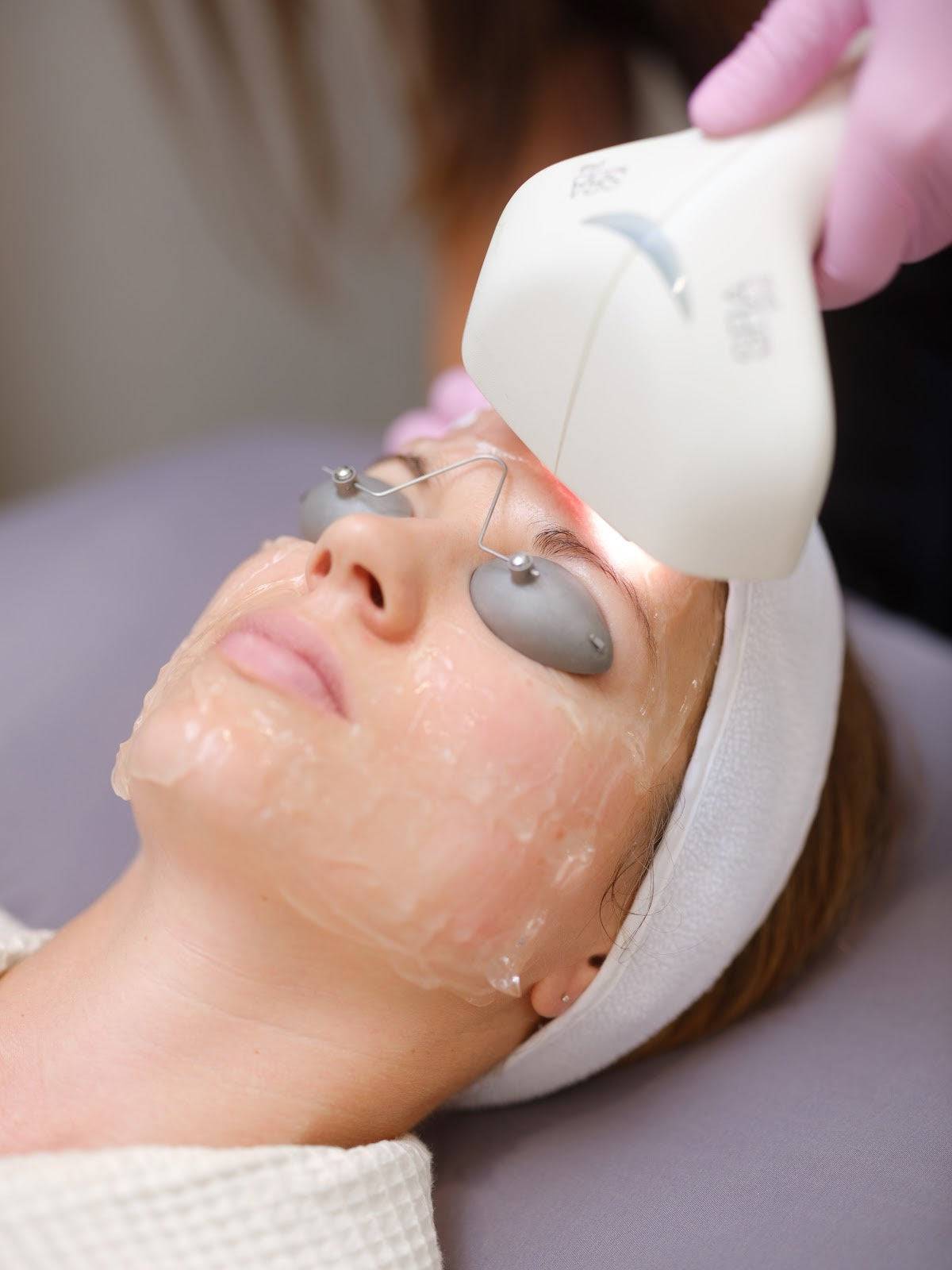 Intense Pulsed Light (IPL)