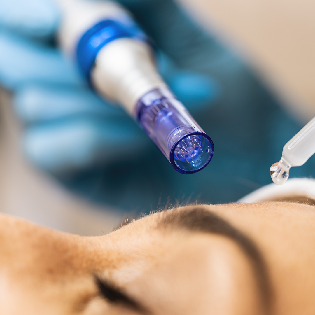 Close-up of a microneedling with PRP treatment device used on skin, highlighting the professional skincare procedure by Longevity Medical Spa.
