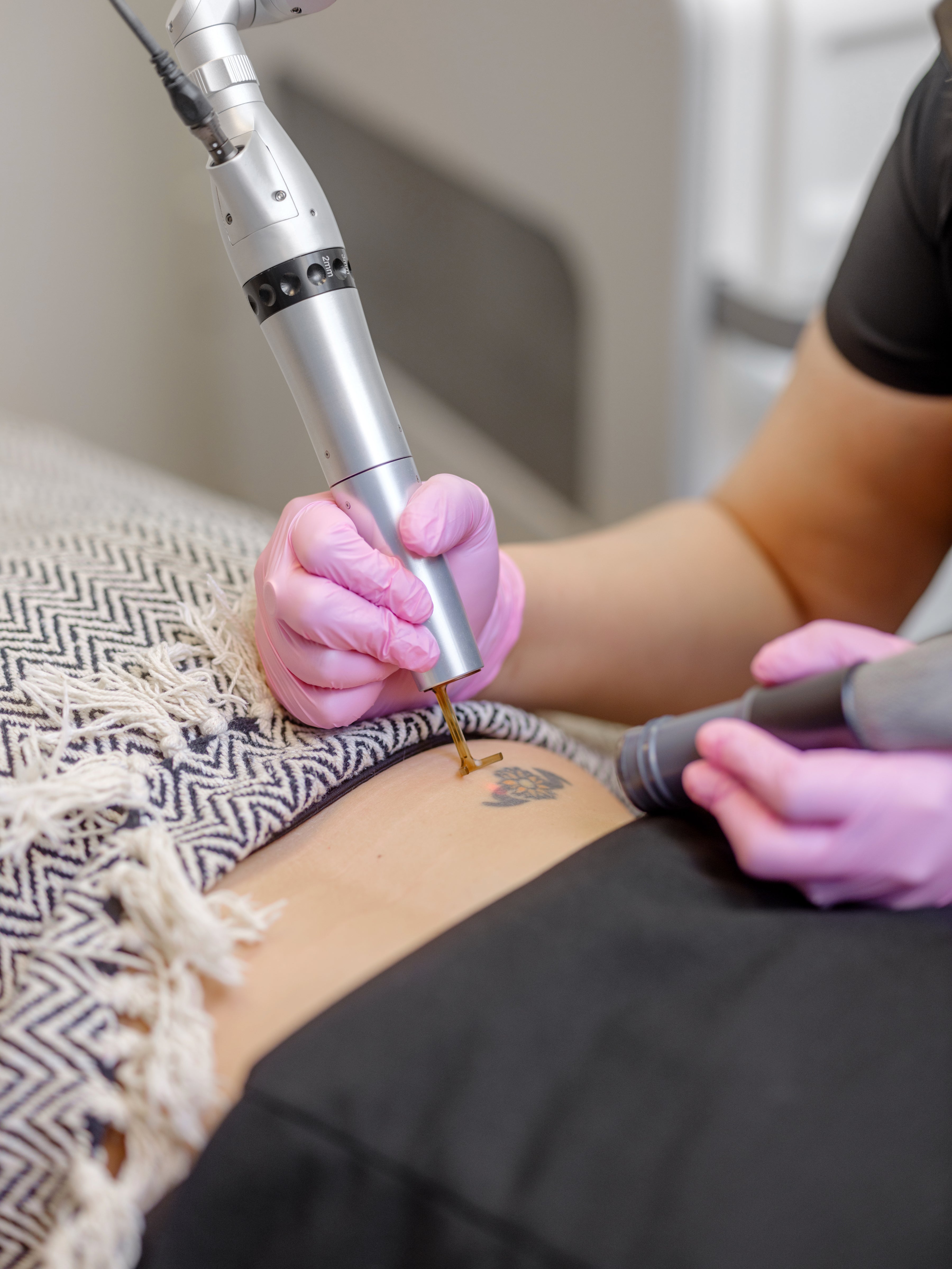 Tattoo Removal 101 - Learn Tattoo Removal