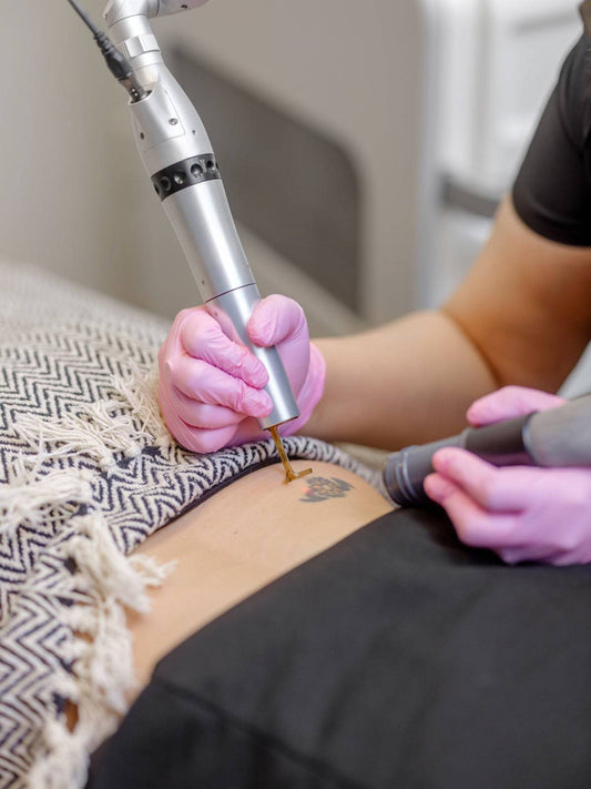 Tattoo Removal Single Sessions - PicoWay Laser