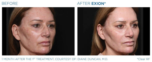 Exion RF Microneedling Before and After