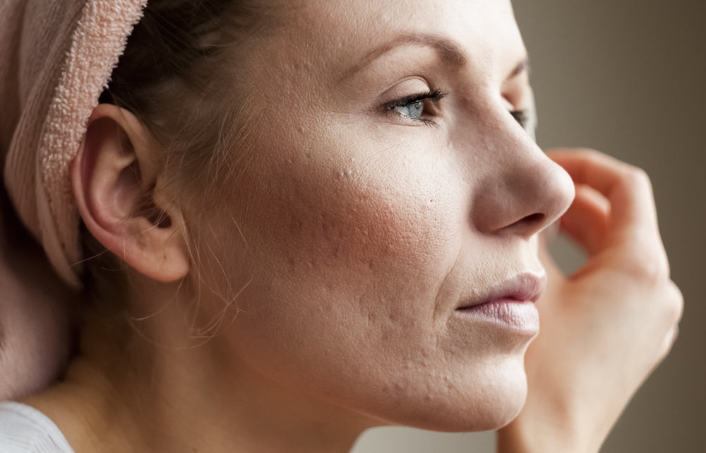 Halo pro-fractional laser treatments